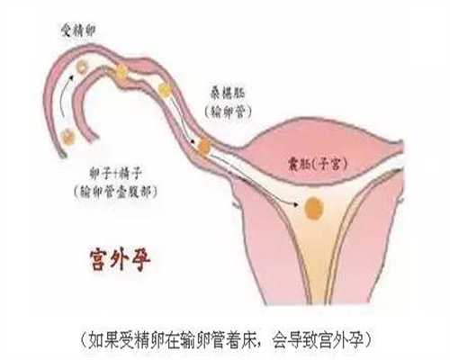 代孕对女性的伤害：输卵管堵塞会引起不孕，该